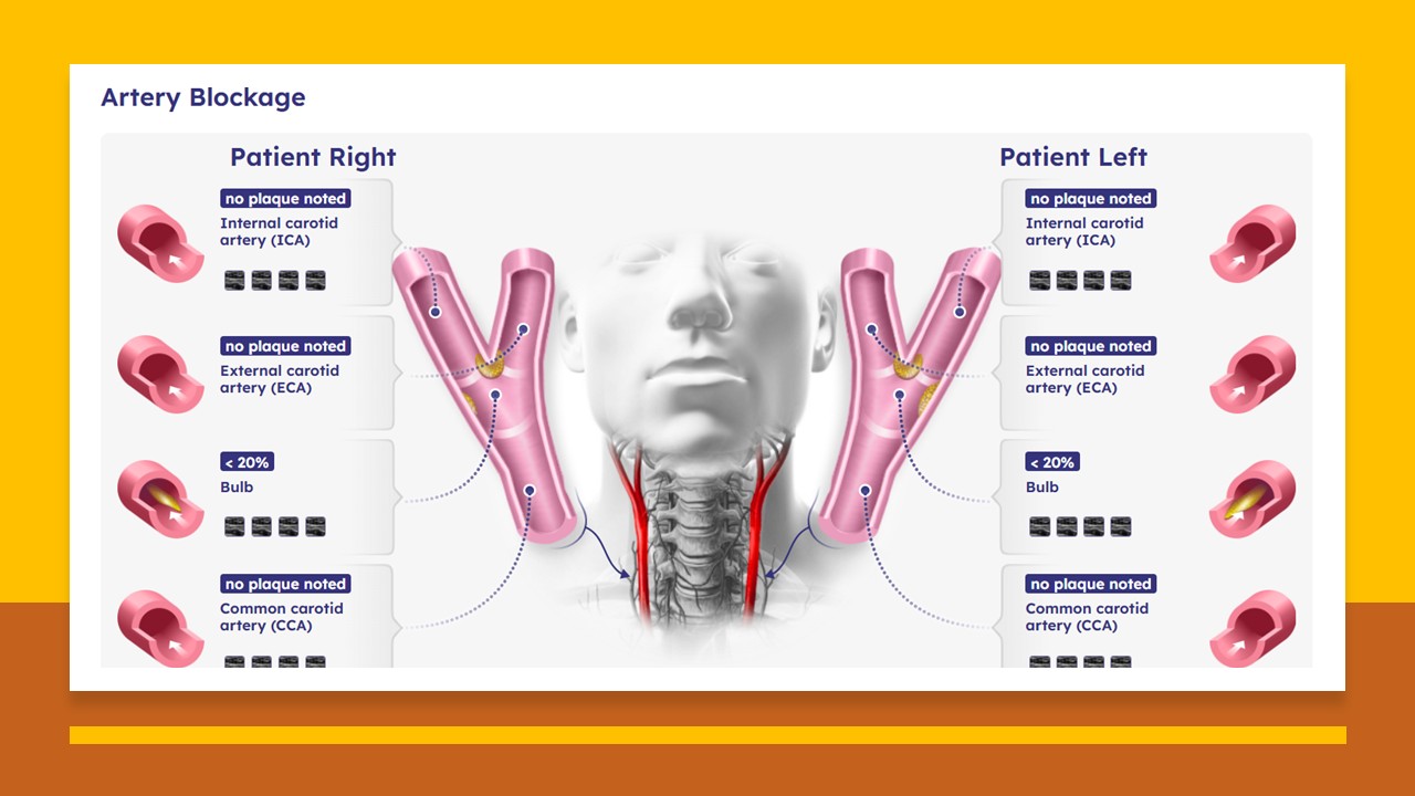 Carotid Ultrasound Exam Results