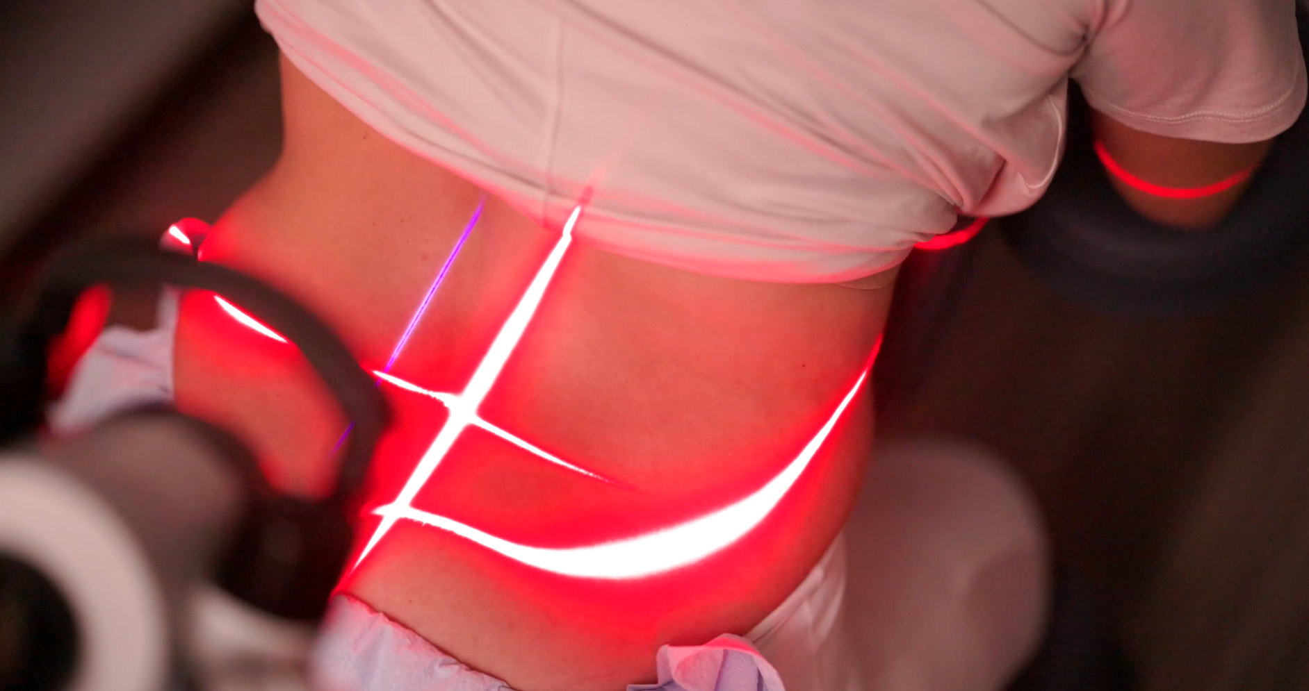 Medical Laser Therapy for Low Back Pain at Functional Medicine Plus Toledo OH